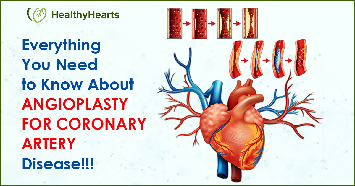 Everything You Need to Know About Angioplasty for Coronary Artery Disease